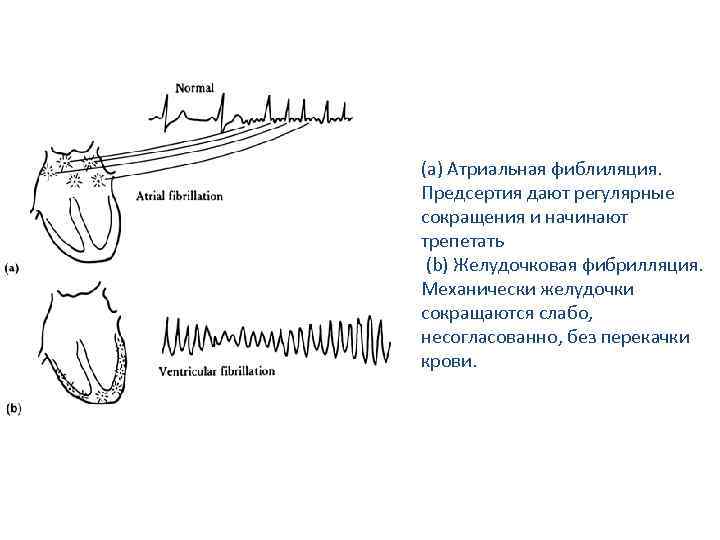 (a) Атриальная фиблиляция. Предсертия дают регулярные сокращения и начинают трепетать (b) Желудочковая фибрилляция. Механически