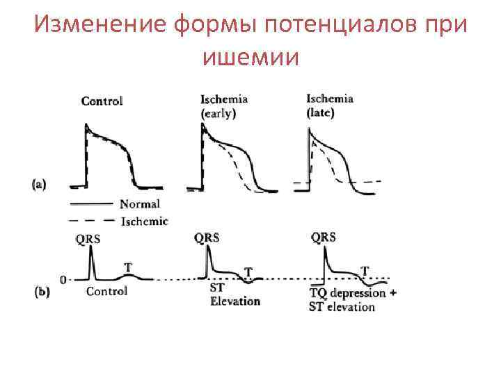 Изменение формы потенциалов при ишемии 
