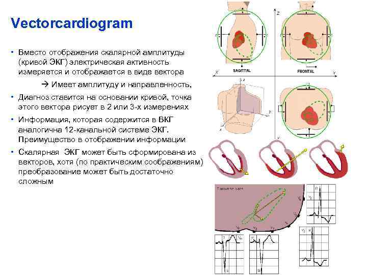 Vectorcardiogram • Вместо отображения скалярной амплитуды (кривой ЭКГ) электрическая активность измеряется и отображается в