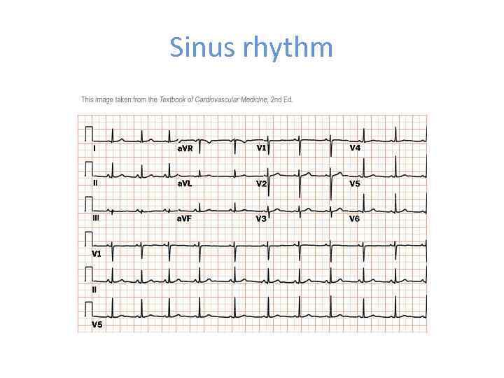 Sinus rhythm 