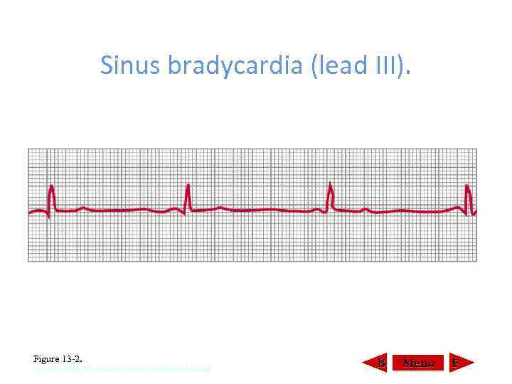 Sinus bradycardia (lead III). Figure 13 2. Copyright 2000, WB Saunders Company, All Rights