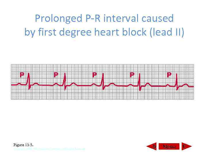 Prolonged P-R interval caused by first degree heart block (lead II) Figure 13 5.