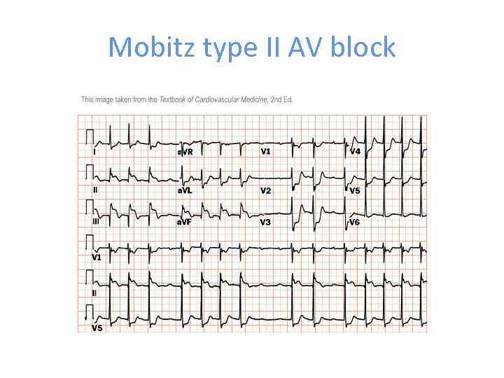 Mobitz type II AV block 