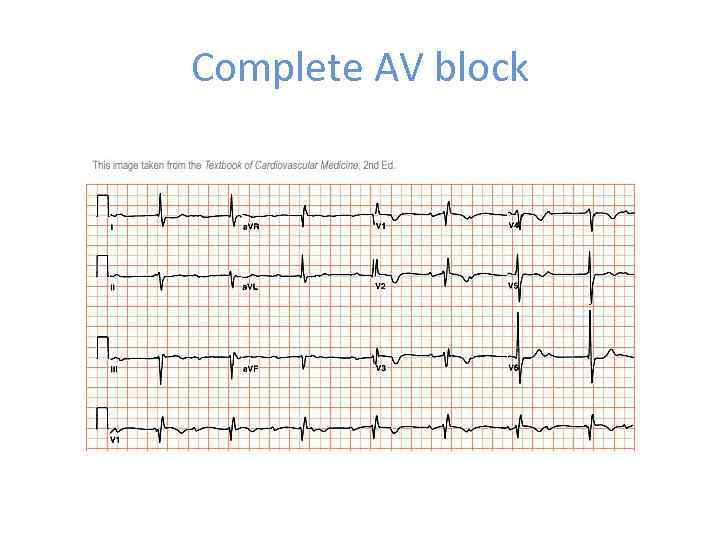 Complete AV block 