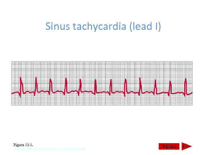 Sinus tachycardia (lead I) Figure 13 1. Copyright 2000, WB Saunders Company, All Rights