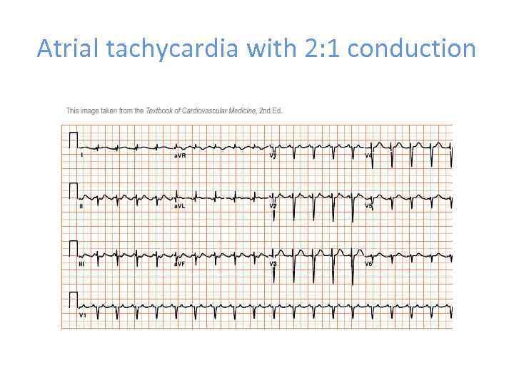 Atrial tachycardia with 2: 1 conduction 