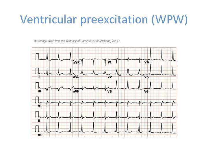 Ventricular preexcitation (WPW) 