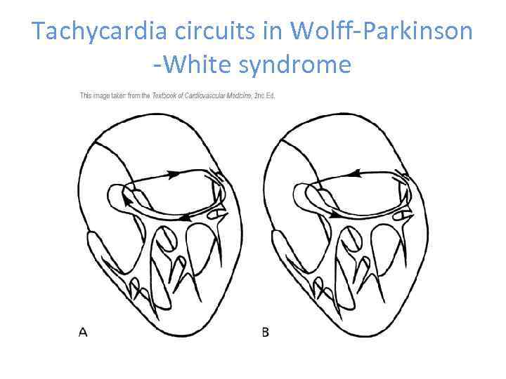 Tachycardia circuits in Wolff-Parkinson -White syndrome 