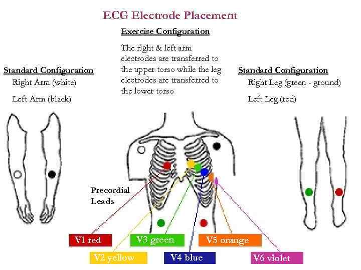 ECG Electrode Placement Exercise Configuration The right & left arm electrodes are transferred to