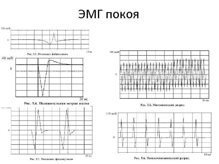 ЭМГ покоя 