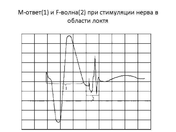 М-ответ(1) и F-волна(2) при стимуляции нерва в области локтя 