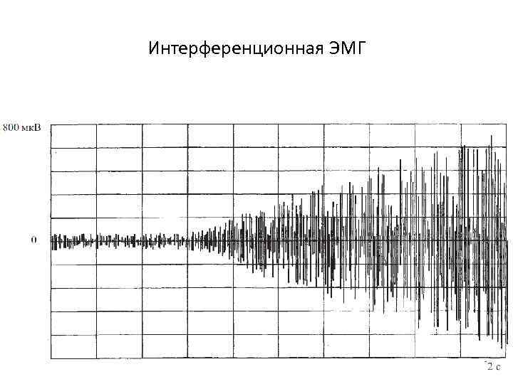 Интерференционная ЭМГ 