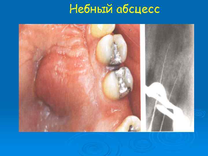 Небный абсцесс 