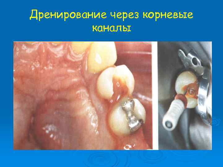 Дренирование через корневые каналы 