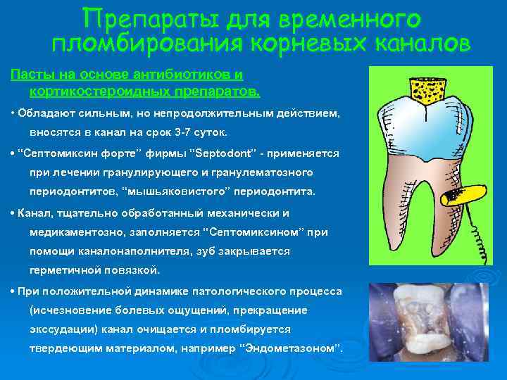 Препараты для временного пломбирования корневых каналов Пасты на основе антибиотиков и кортикостероидных препаратов. •