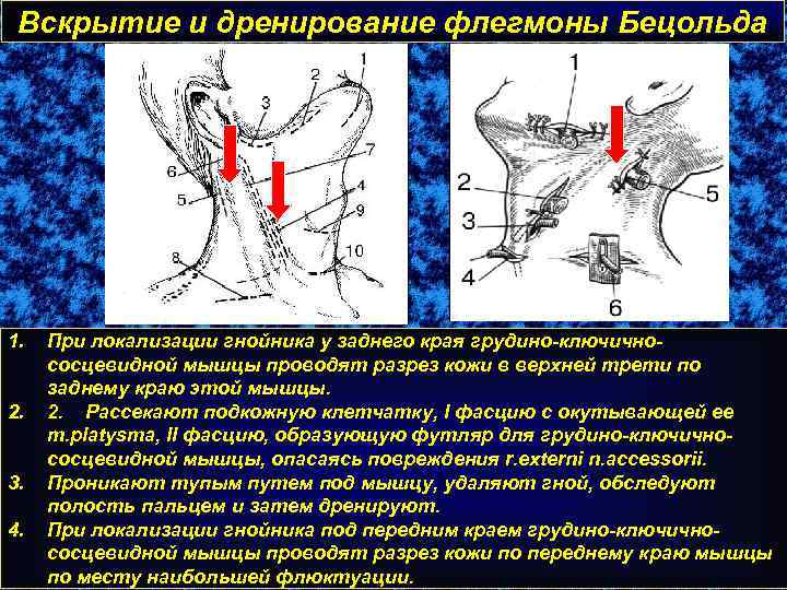 Вскрытие и дренирование флегмоны Бецольда 1. 2. 3. 4. При локализации гнойника у заднего