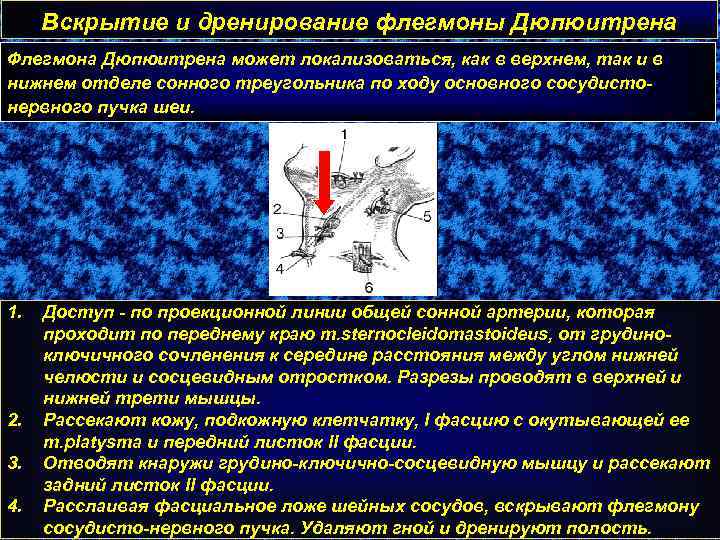 Вскрытие и дренирование флегмоны Дюпюитрена Флегмона Дюпюитрена может локализоваться, как в верхнем, так и