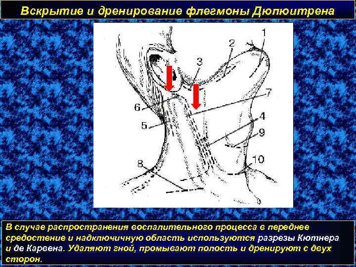 Вскрытие и дренирование флегмоны Дюпюитрена В случае распространения воспалительного процесса в переднее средостение и