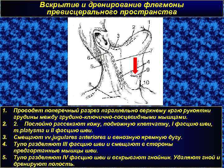 Вскрытие и дренирование флегмоны превисцерального пространства 1. 2. 3. 4. 5. Проводят поперечный разрез