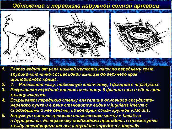 Обнажение и перевязка наружной сонной артерии 1. 2. 3. 4. 5. Разрез ведут от