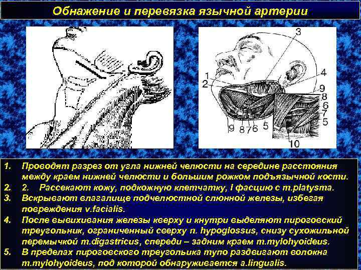 Обнажение и перевязка язычной артерии 1. 2. 3. 4. 5. Проводят разрез от угла