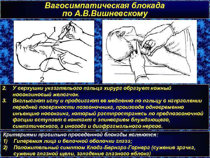 Вагосимпатическая блокада по А. В. Вишневскому 2. 3. У верхушки указателього пальца хирург образует