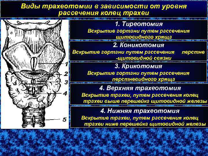 Виды трахеотомии в зависимости от уровня рассечения колец трахеи 1. Тиреотомия Вскрытие гортани путем