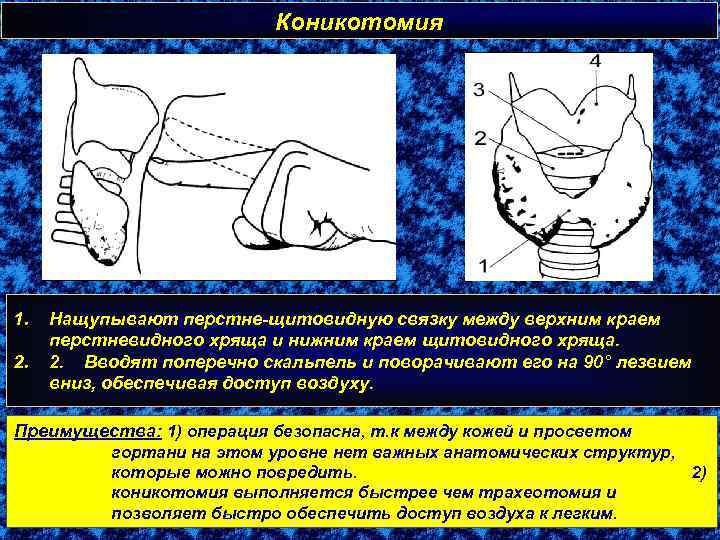 Коникотомия 1. 2. Нащупывают перстне-щитовидную связку между верхним краем перстневидного хряща и нижним краем