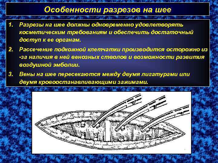 Особенности разрезов на шее 1. Разрезы на шее должны одновременно удовлетворять косметическим требованиям и