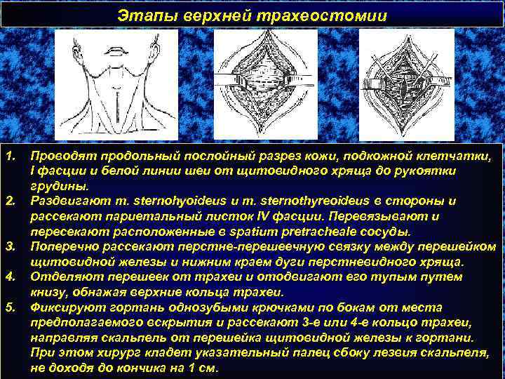 Этапы верхней трахеостомии 1. 2. 3. 4. 5. Проводят продольный послойный разрез кожи, подкожной