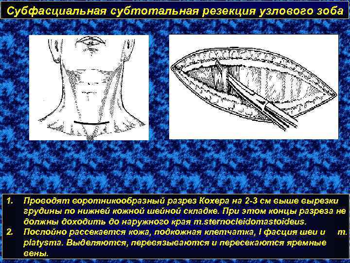 Субфасциальная субтотальная резекция узлового зоба 1. 2. Проводят воротникообразный разрез Кохера на 2 -3