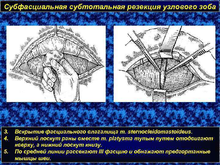 Субфасциальная субтотальная резекция узлового зоба 3. 4. 5. Вскрытие фасциального влагалища m. sternocleidomastoideus. Верхний