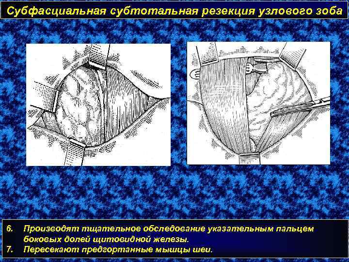 Субфасциальная субтотальная резекция узлового зоба 6. 7. Производят тщательное обследование указательным пальцем боковых долей