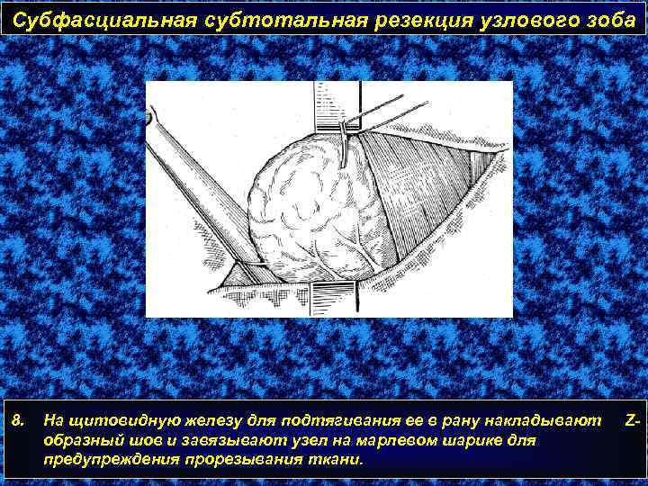 Субфасциальная субтотальная резекция узлового зоба 8. На щитовидную железу для подтягивания ее в рану