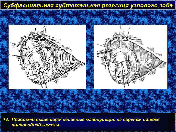 Субфасциальная субтотальная резекция узлового зоба 12. Проводят выше перечисленные манипуляции на верхнем полюсе щитовидной