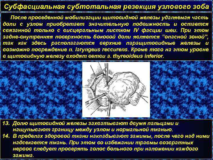 Субфасциальная субтотальная резекция узлового зоба После проведенной мобилизации щитовидной железы удаляемая часть доли с