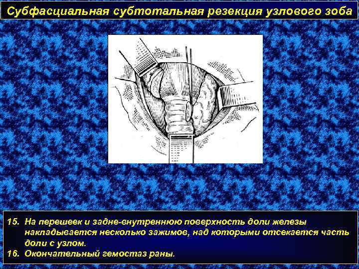 Субфасциальная субтотальная резекция узлового зоба 15. На перешеек и задне-внутреннюю поверхность доли железы накладывается