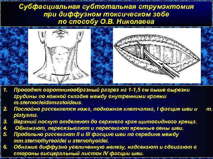 Субфасциальная субтотальная струмэктомия при диффузном токсическом зобе по способу О. В. Николаева 1. 2.