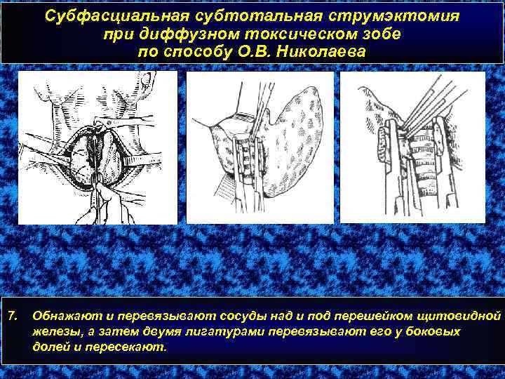 Субфасциальная субтотальная струмэктомия при диффузном токсическом зобе по способу О. В. Николаева 7. Обнажают