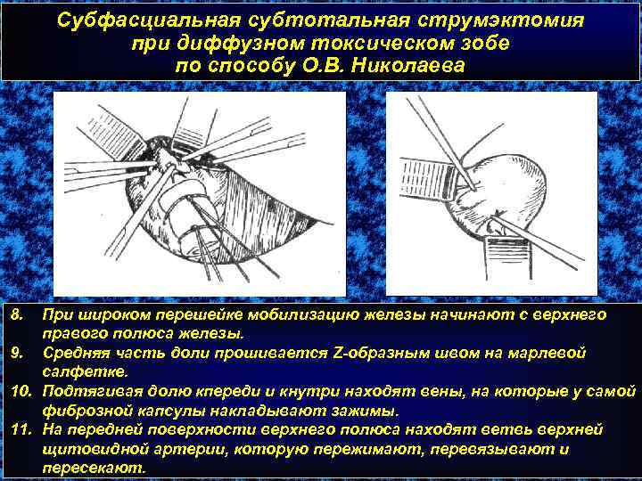 Субфасциальная субтотальная струмэктомия при диффузном токсическом зобе по способу О. В. Николаева 8. При