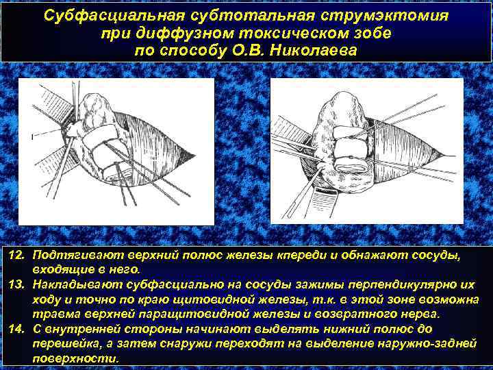 Субфасциальная субтотальная струмэктомия при диффузном токсическом зобе по способу О. В. Николаева 12. Подтягивают