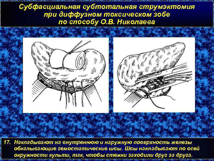 Субфасциальная субтотальная струмэктомия при диффузном токсическом зобе по способу О. В. Николаева 17. Накладывают