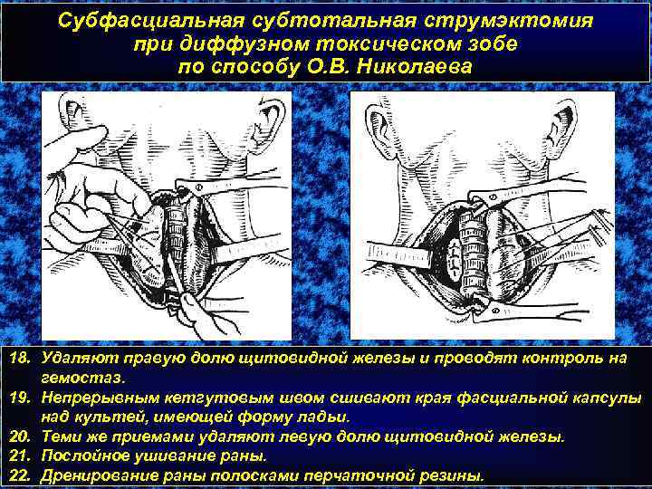 Субфасциальная субтотальная струмэктомия при диффузном токсическом зобе по способу О. В. Николаева 18. Удаляют