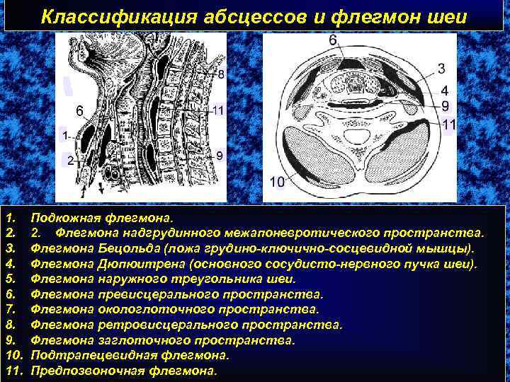 Классификация абсцессов и флегмон шеи 1. 2. 3. 4. 5. 6. 7. 8. 9.