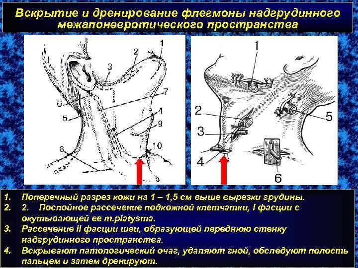 Вскрытие и дренирование флегмоны надгрудинного межапоневротического пространства 1. 2. 3. 4. Поперечный разрез кожи