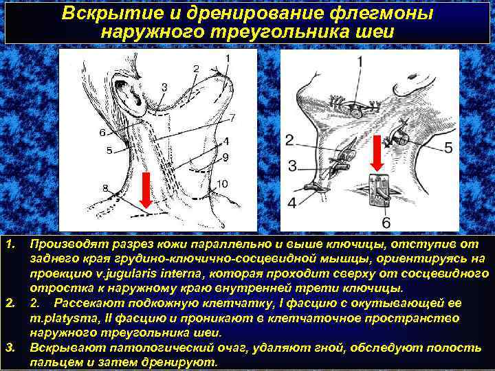 Вскрытие и дренирование флегмоны наружного треугольника шеи 1. 2. 3. Производят разрез кожи параллельно