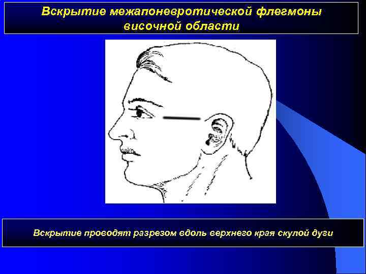 Вскрытие межапоневротической флегмоны височной области Вскрытие проводят разрезом вдоль верхнего края скулой дуги 