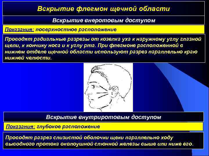 Вскрытие флегмон щечной области Вскрытие внеротовым доступом Показания: поверхностное расположение Проводят радиальные разрезы от