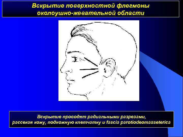 Вскрытие поверхностной флегмоны околоушно-жевательной области Вскрытие проводят радиальными разрезами, рассекая кожу, подкожную клетчатку и