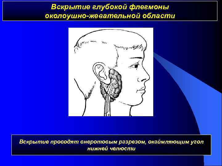 Флегмона челюсти фото